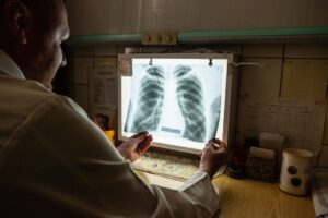 В Україні з’являються випадки позалегеневого туберкульозу – ЦГЗ